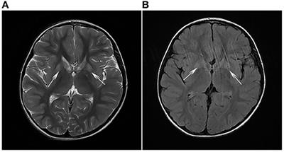 Complicated Hereditary Spastic Paraplegia Caused by SERAC1 Variants in a Chinese Family